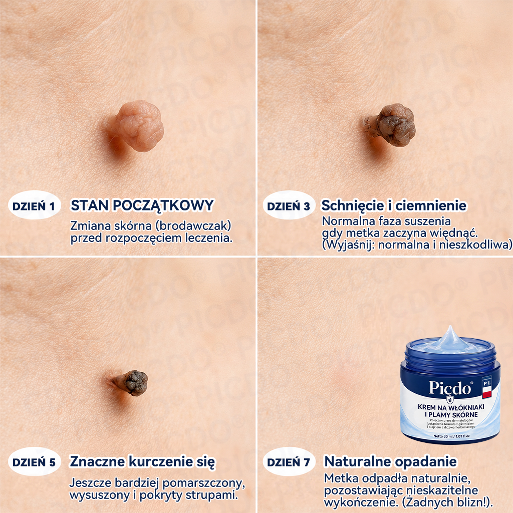 𝐏𝐢𝐜𝐝𝐨® 𝟕-𝐝𝐧𝐢𝐨𝐰𝐲 𝐤𝐫𝐞𝐦 𝐝𝐨 𝐮𝐬𝐮𝐰𝐚𝐧𝐢𝐚 𝐧𝐚𝐫𝐨ś𝐥𝐢 𝐬𝐤ó𝐫𝐧𝐲𝐜𝐡 𝐢 𝐩𝐥𝐚𝐦 𝐩𝐢𝐠𝐦𝐞𝐧𝐭𝐚𝐜𝐲𝐣𝐧𝐲𝐜𝐡  (𝐒𝐜𝐡𝐦𝐞𝐫𝐳𝐟𝐫𝐞𝐢𝐞 𝐅𝐨𝐫𝐦𝐞𝐥 – 𝐨𝐡𝐧𝐞 𝐍𝐚𝐫𝐛𝐞𝐧)🍈