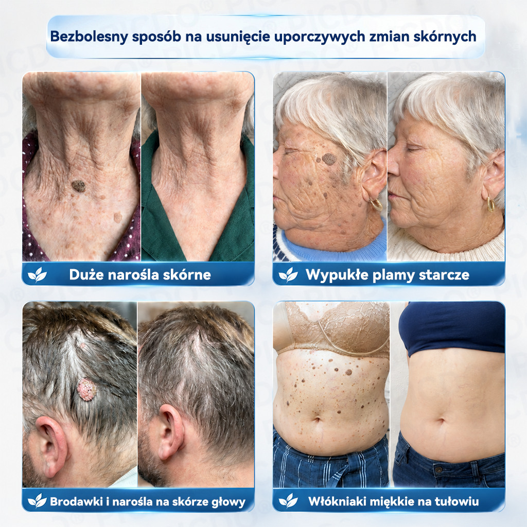 𝐏𝐢𝐜𝐝𝐨® 𝟕-𝐝𝐧𝐢𝐨𝐰𝐲 𝐤𝐫𝐞𝐦 𝐝𝐨 𝐮𝐬𝐮𝐰𝐚𝐧𝐢𝐚 𝐧𝐚𝐫𝐨ś𝐥𝐢 𝐬𝐤ó𝐫𝐧𝐲𝐜𝐡 𝐢 𝐩𝐥𝐚𝐦 𝐩𝐢𝐠𝐦𝐞𝐧𝐭𝐚𝐜𝐲𝐣𝐧𝐲𝐜𝐡  (𝐒𝐜𝐡𝐦𝐞𝐫𝐳𝐟𝐫𝐞𝐢𝐞 𝐅𝐨𝐫𝐦𝐞𝐥 – 𝐨𝐡𝐧𝐞 𝐍𝐚𝐫𝐛𝐞𝐧)🍈