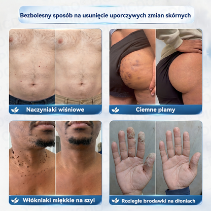 𝐏𝐢𝐜𝐝𝐨® 𝟕-𝐝𝐧𝐢𝐨𝐰𝐲 𝐤𝐫𝐞𝐦 𝐝𝐨 𝐮𝐬𝐮𝐰𝐚𝐧𝐢𝐚 𝐧𝐚𝐫𝐨ś𝐥𝐢 𝐬𝐤ó𝐫𝐧𝐲𝐜𝐡 𝐢 𝐩𝐥𝐚𝐦 𝐩𝐢𝐠𝐦𝐞𝐧𝐭𝐚𝐜𝐲𝐣𝐧𝐲𝐜𝐡  (𝐒𝐜𝐡𝐦𝐞𝐫𝐳𝐟𝐫𝐞𝐢𝐞 𝐅𝐨𝐫𝐦𝐞𝐥 – 𝐨𝐡𝐧𝐞 𝐍𝐚𝐫𝐛𝐞𝐧)🍈