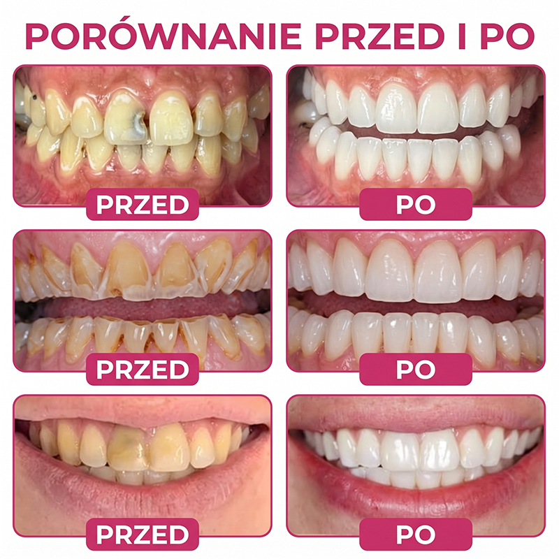 Rolimey® DenPerm – Naturalny żel wypełniający szkliwo do leczenia ubytków próchnicowych🧨
