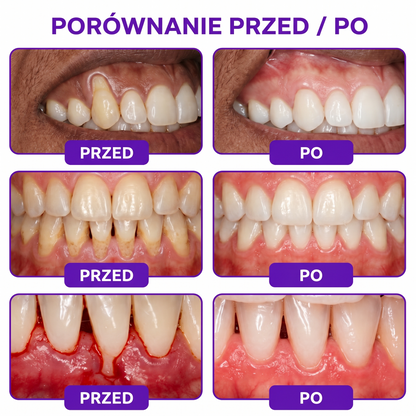 🦷 Rolimey® VioCore™ |  Zaawansowana pielęgnacja dziąseł i zębów 🍇