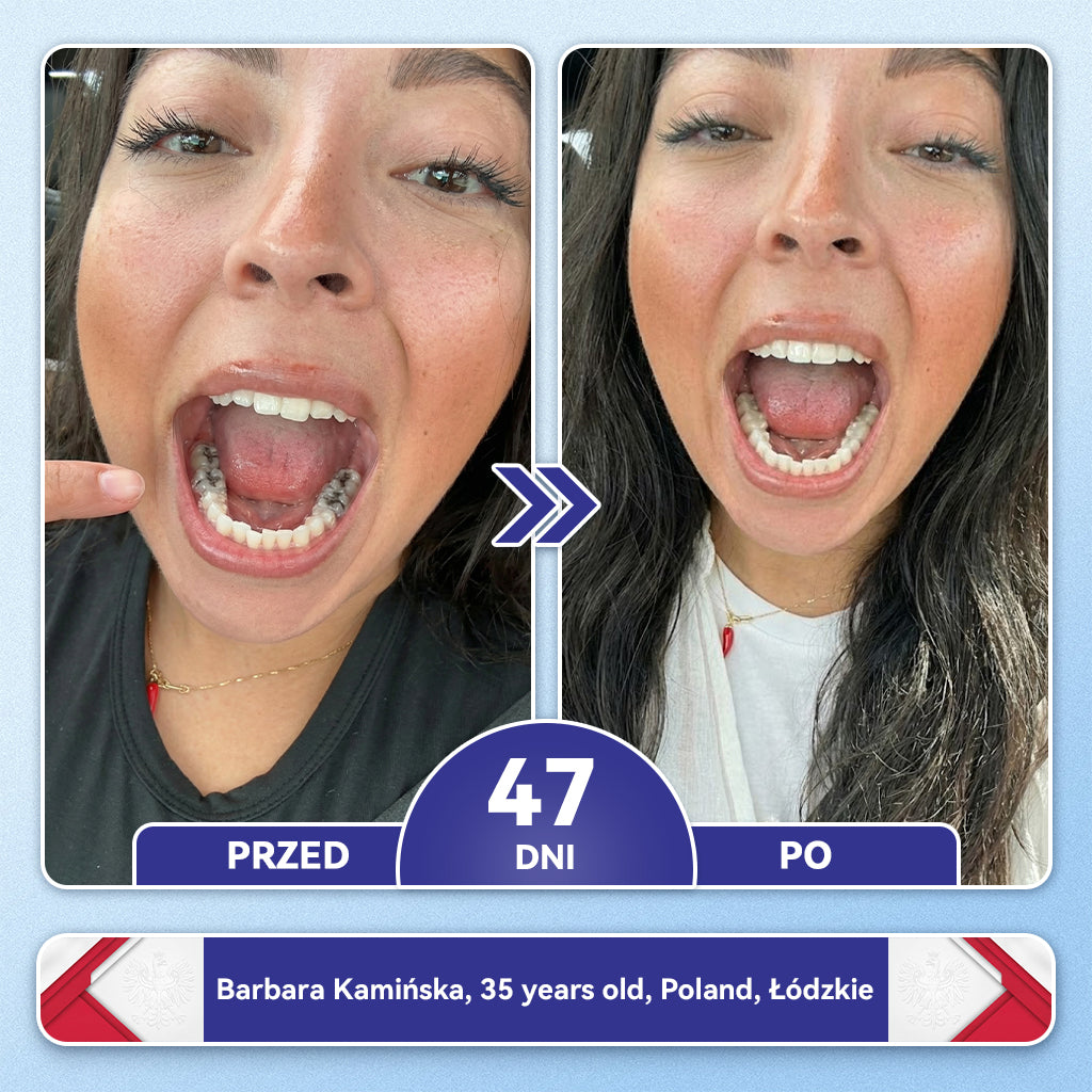 🦷 𝐆𝐥𝐢𝐦𝐦𝐞𝐫𝐥𝐲® 𝐓𝐢𝐝𝐞𝐠𝐥𝐮𝐬𝐢𝐛 Płatki Mikronakłuwające do Naprawy Zębów i Dziąseł | Zaawansowana Aktywacja Komórek Macierzystych – Strips do Naprawy Zębów