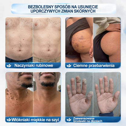Oficjalny Sklep Markowy | ✅👩‍⚕️ 𝐏i𝐜𝐝o® 7-Dniowy 𝗧𝗮𝗴 & 𝗦𝗽𝗼𝐭 𝐄𝐫𝐚𝐬𝐞𝐫 (Bez bólu, Bez blizn – aplikator z kulką) 🎉