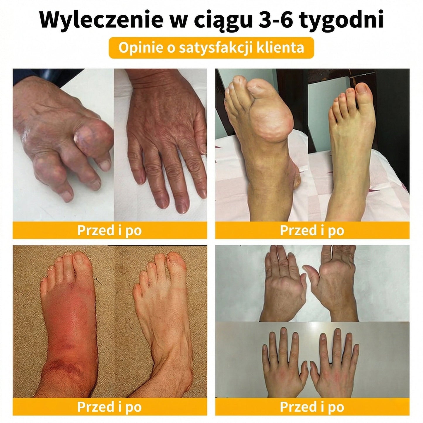 ✅Oficjalny sklep: 𝑭𝑨𝑻𝑶𝑵𝑮® Krem z jadem pszczelim – Uśmierzanie bólu i regeneracja kości 👨‍⚕️ Rekomendowany przez Amerykańską Akademię Chirurgów Ortopedycznych (AAOS) 💖 Oferta specjalna – ograniczony czas