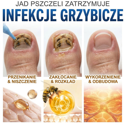 🇪🇺 Certyfikowany w UE 👩‍🔬 CareBreeze® Fungi Free – Intensywna Kuracja do Paznokci na Bazie Jadu Pszczelego 🍼