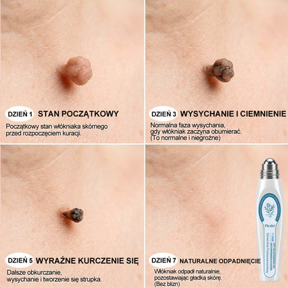 Oficjalny Sklep Markowy | ✅👩‍⚕️ 𝐏i𝐜𝐝o® 7-Dniowy 𝗧𝗮𝗴 & 𝗦𝗽𝗼𝐭 𝐄𝐫𝐚𝐬𝐞𝐫 (Bez bólu, Bez blizn – aplikator z kulką) 🎉