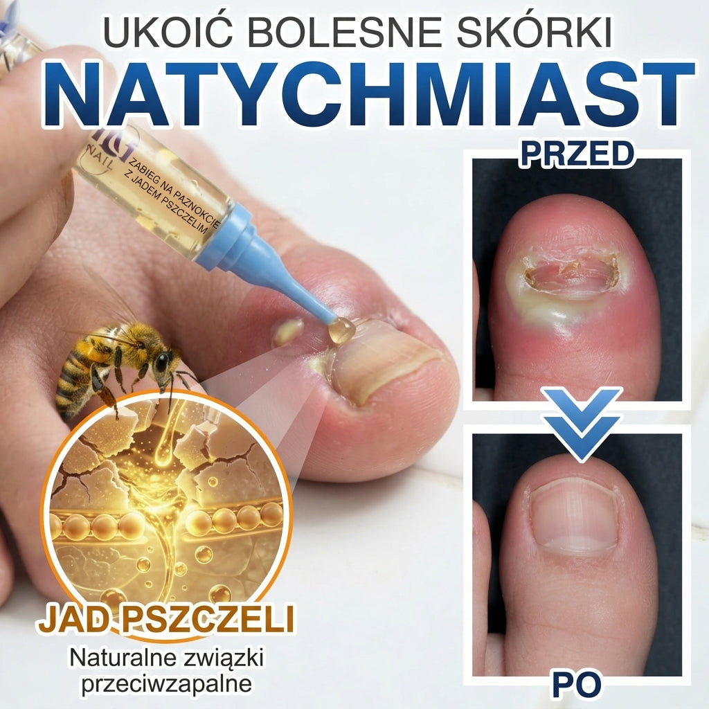 🇪🇺 Certyfikowany w UE 👩‍🔬 CareBreeze® Fungi Free – Intensywna Kuracja do Paznokci na Bazie Jadu Pszczelego 🍼