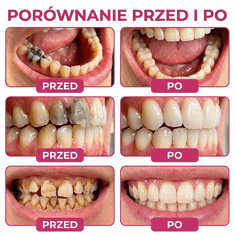 Rolimey® DenPerm – Naturalny żel wypełniający szkliwo do leczenia ubytków próchnicowych🧨