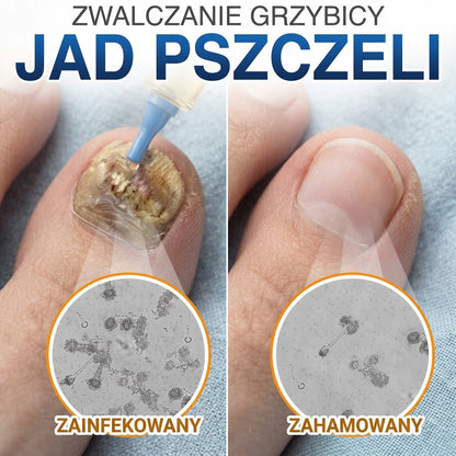 🇪🇺 Certyfikowany w UE 👩‍🔬 CareBreeze® Fungi Free – Intensywna Kuracja do Paznokci na Bazie Jadu Pszczelego 🍼